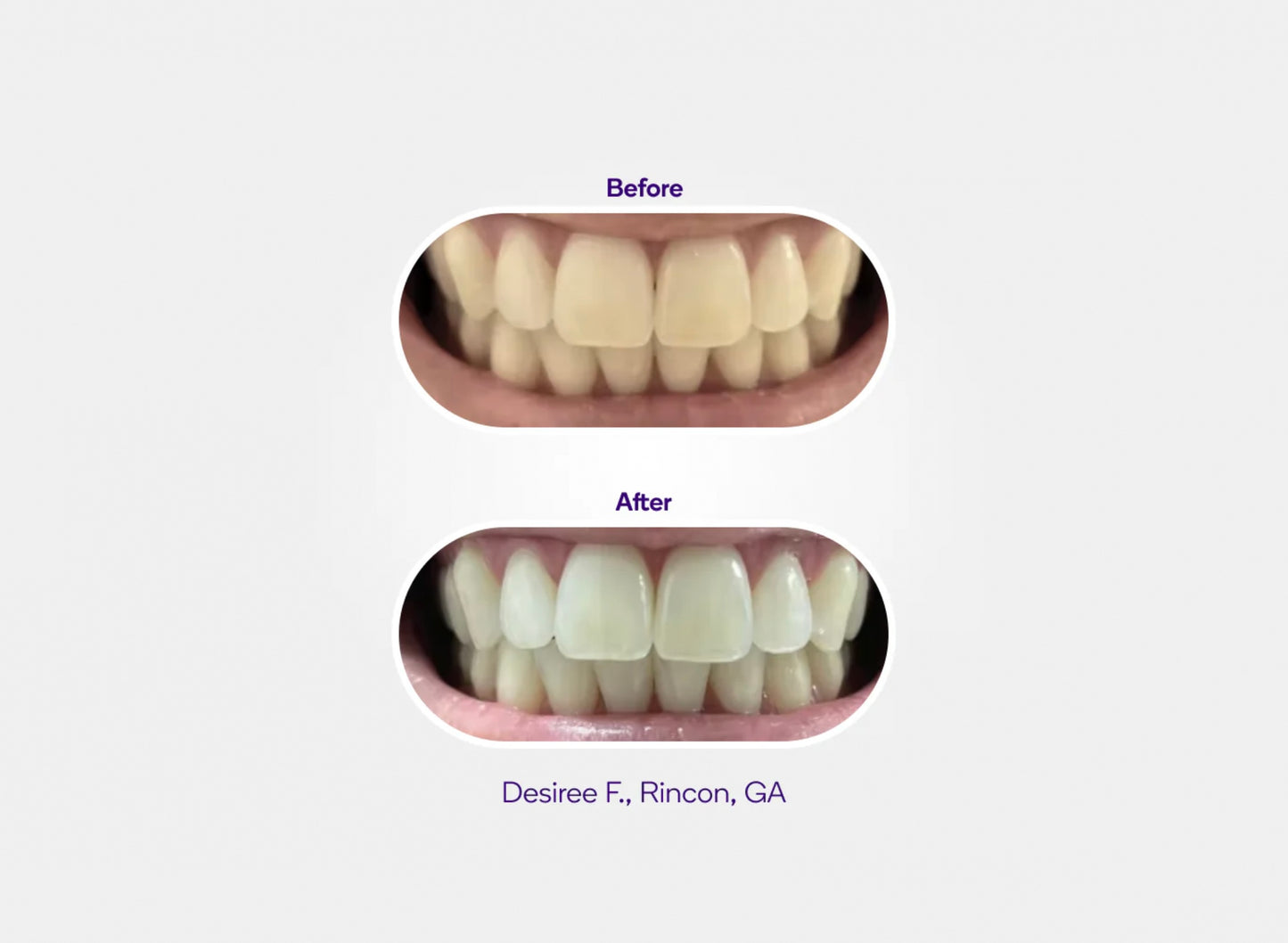 Prefilled Whitening Trays 7 pack