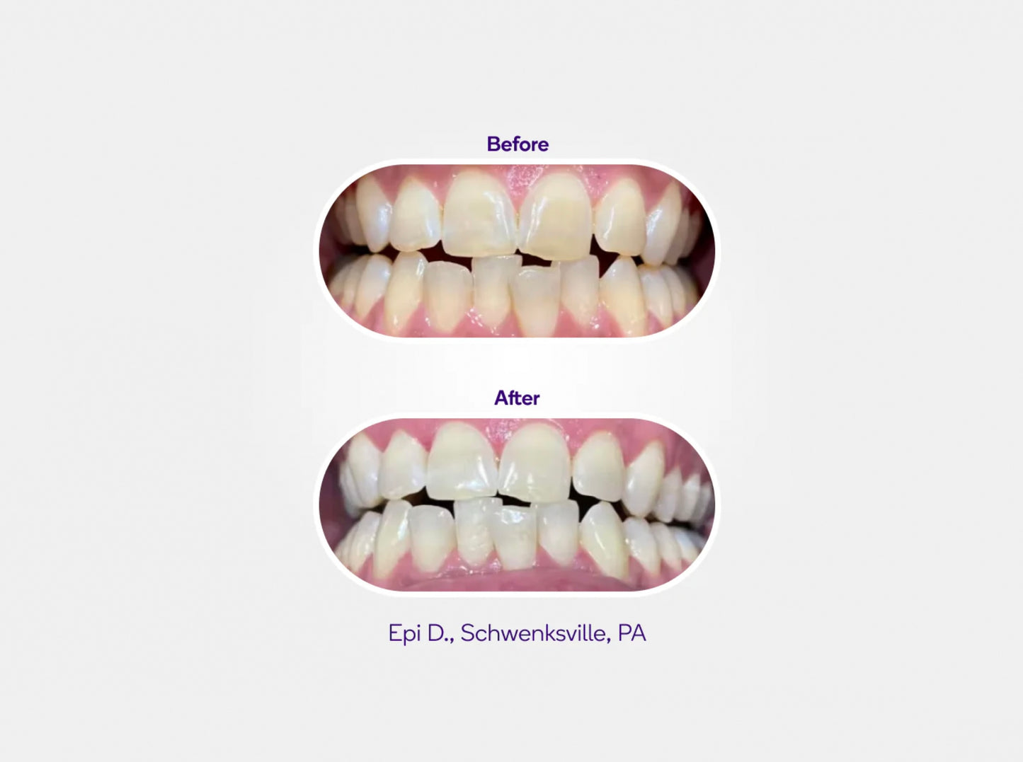 Prefilled Whitening Trays 7 pack